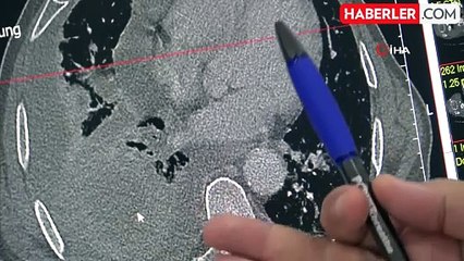 Türkiye'de Akciğer Kanseri Vakaları 40 Bini Aşıyor