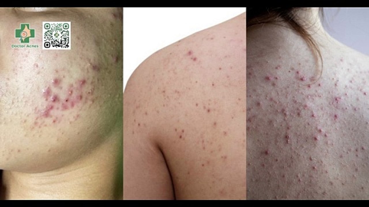Mụn trứng cá: nguyên nhân, cách điều trị và phòng ngừa mụn