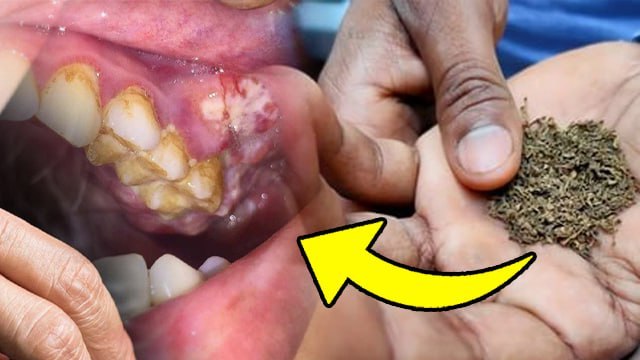 Oral Cancer Causes: Mouth Cancer Kyu Aur Kaise Hota Hai, Symptoms In Hindi