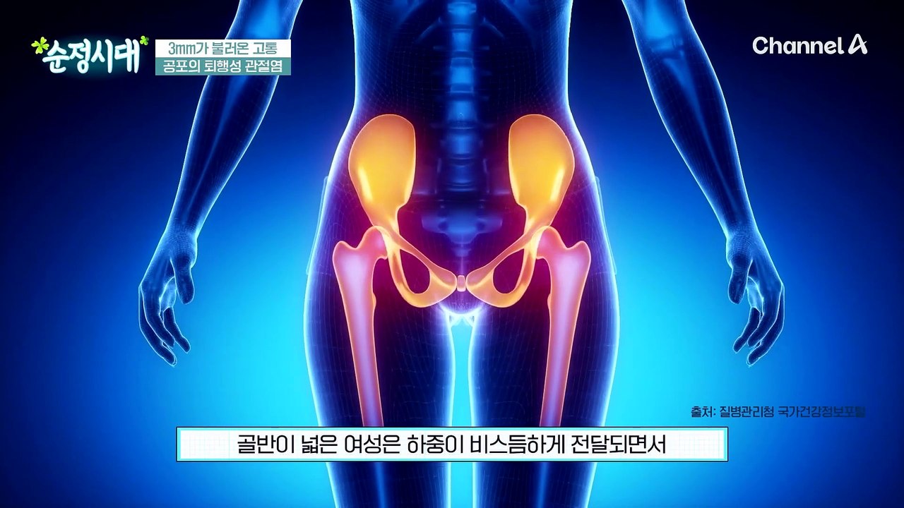 파스 없이는 못 살아! 일상생활에 고통을 주는 관절염을 예방하라!