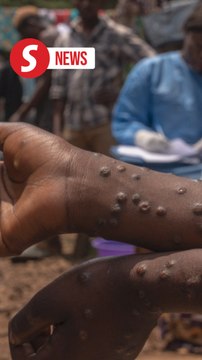 No new cases of mpox detected in Malaysia, says Dzulkefly