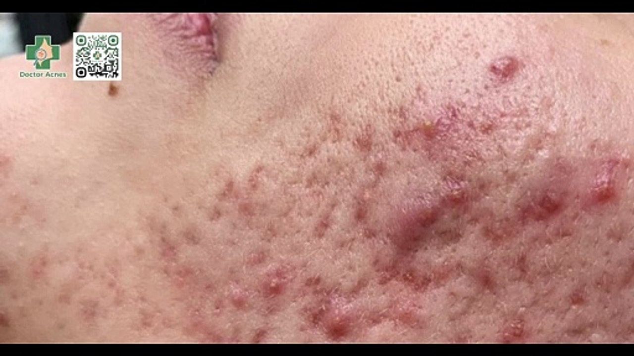 Sẹo lõm có tự đầy không? Cách điều trị và phòng ngừa sẹo lõm