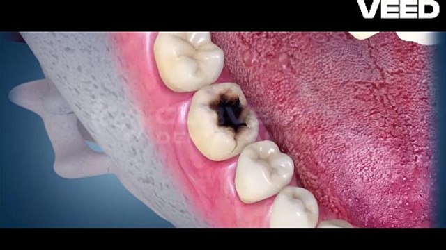 Root Canal Treatment | RCT IN Vadodara