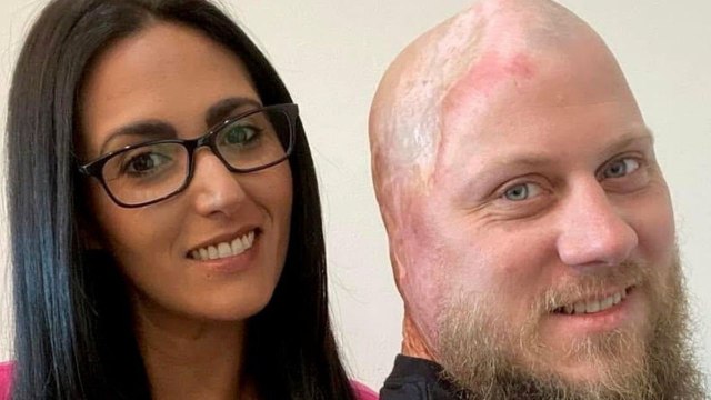 „Ich hatte eine Überlebenschance von 5%, nachdem mein Kopf durch 4.160 Volt einen Stromschlag erlitten hatte.“