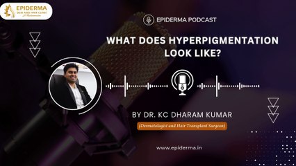 Podcast: What does hyperpigmentation look like | Epiderma Skin and Hair Clinic in Jayanagar