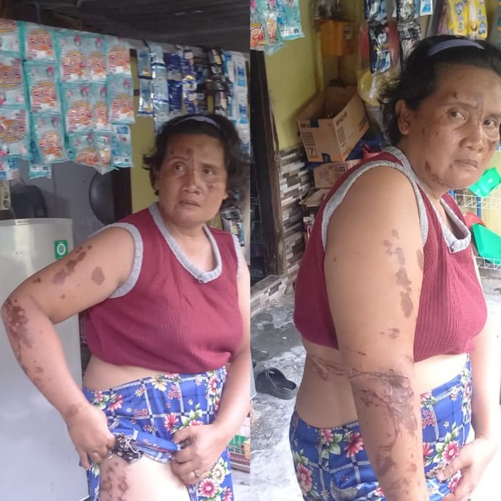 Ibu Rumah Tangga di Palembang Disiram Air Keras oleh Tetangga