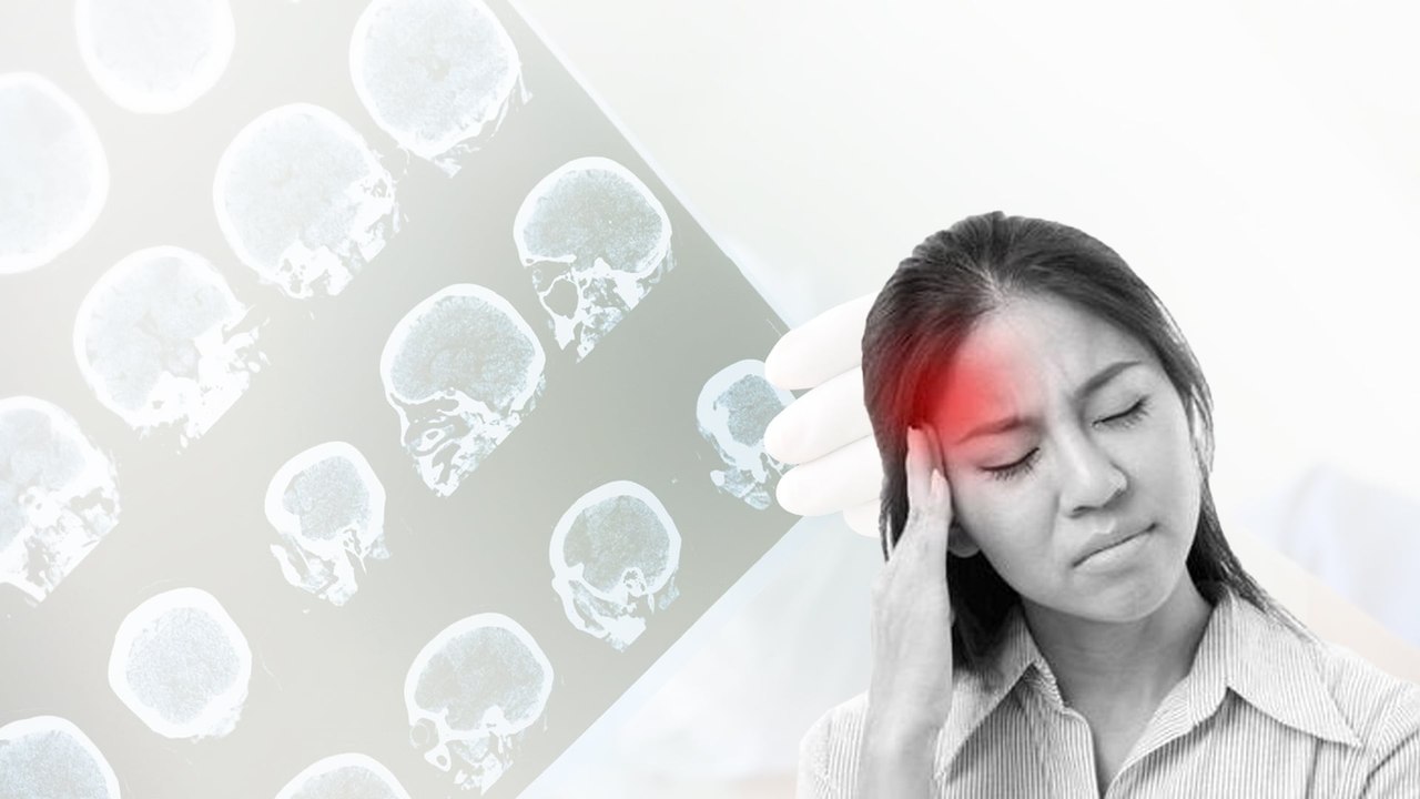 Thiếu máu não thoáng qua: Cảnh báo đỏ cho đột quỵ sắp xảy ra!