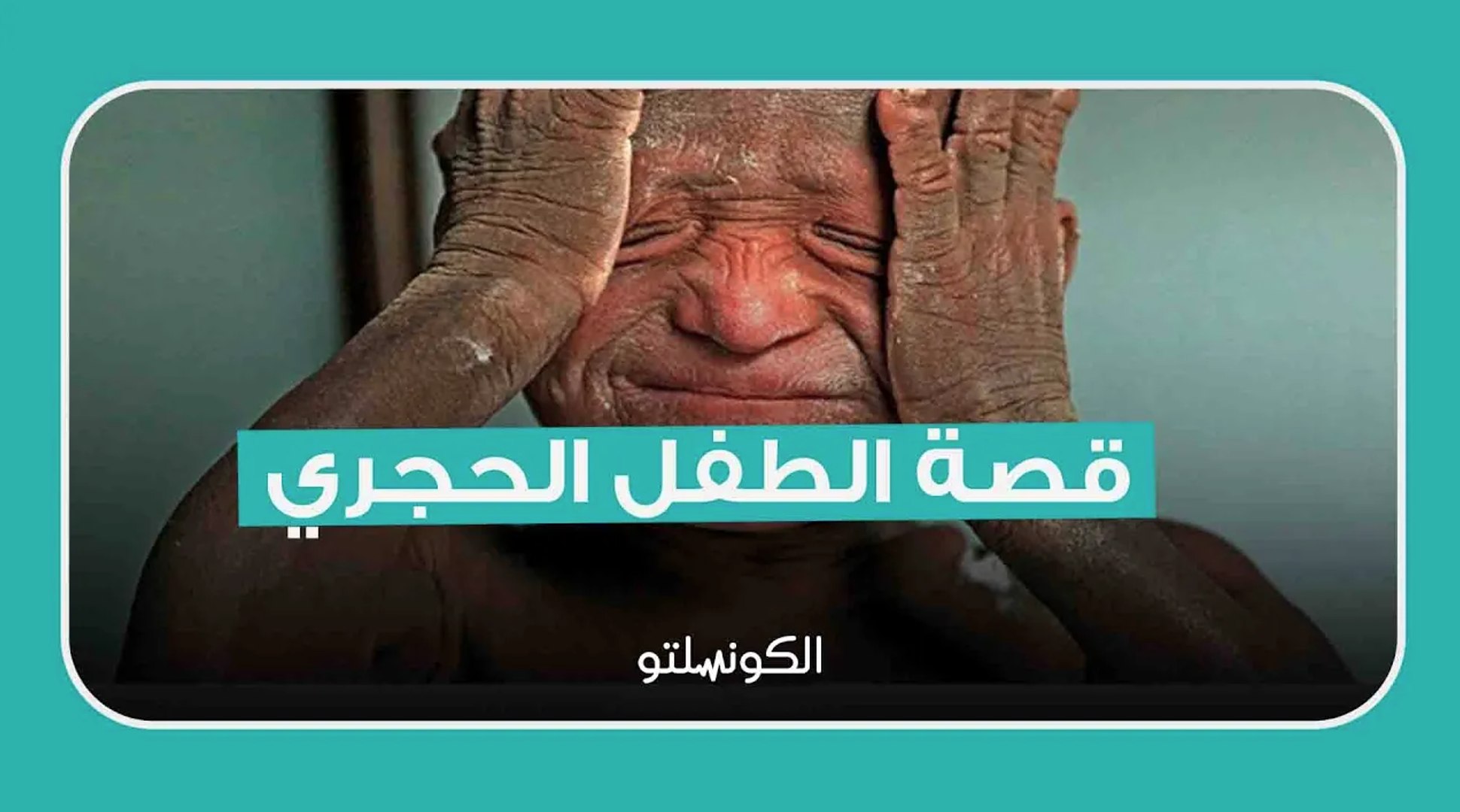 ⁣مرض يُحول طفل لتمثال حي- ماذا حدث؟