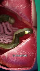 How A Colonoscopy Works 🤔