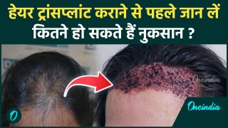 Hair Transplant Side Effect: हेयर ट्रांसप्लांट के कितने नुकसान, खुजली, सूजन, इनफेक्सन और बहुत कुछ