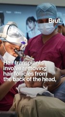 Myths about hair transplants