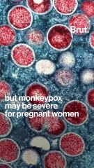 What is it like to have monkeypox?