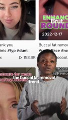 Explaining buccal fat removal surgery