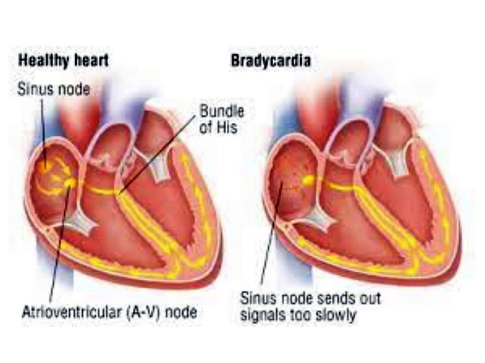 Atrial fibrillation in hindi || What is atrial fibrillation