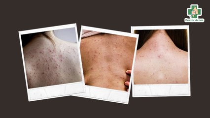 Mụn trứng cá ở lưng: nguyên nhân, cách điều trị và phòng ngừa