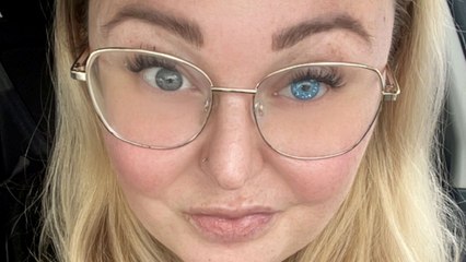 Mum fitted with glittery false eye after having it removed due to rare condition