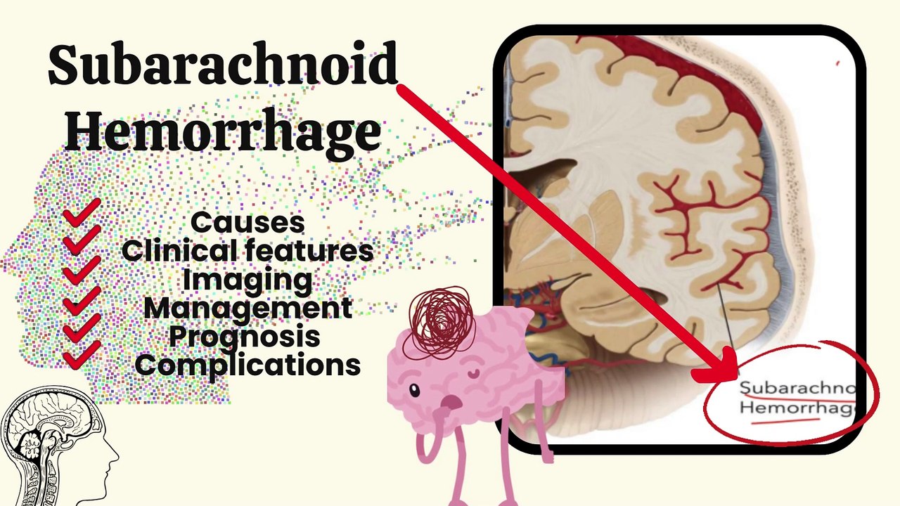 Subarachnoid Hemorrhage | Types, Cause, Clinical Features, CT Scan, Treatment | Hemorrhagic Stroke