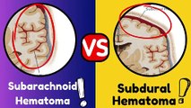 Subarachnoid Hematoma (SAH) vs. Subdural Hematoma (SDH): Key Differences Explained
