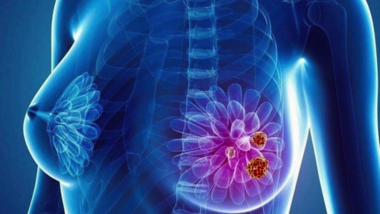 Bệnh viện EMCAS và Siemens Healthineers tầm soát ung thư vú miễn phí