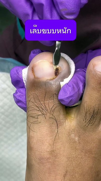 Trim ingrown toenails all the way to the nail root. The advantage is that there is no remaining nail stump inside. Helps to heal from ingrown toenails or recurring ingrown toenails more slowly.
