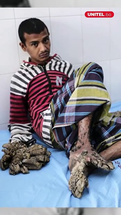 El extraño síndrome del hombre árbol ¿Qué es y cómo afecta a quienes padecen esta enfermedad?