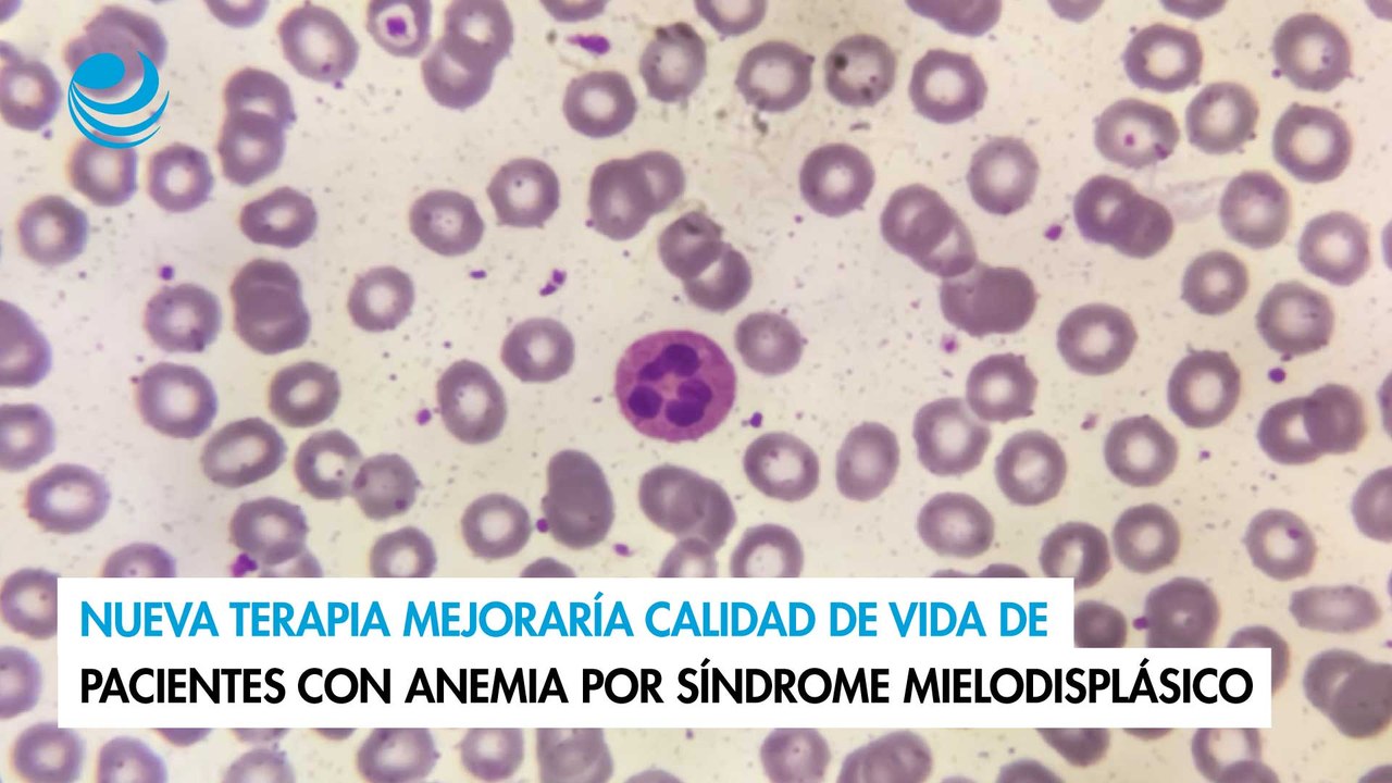 Nueva terapia mejoraría calidad de vida de pacientes con anemia por síndrome mielodisplásico