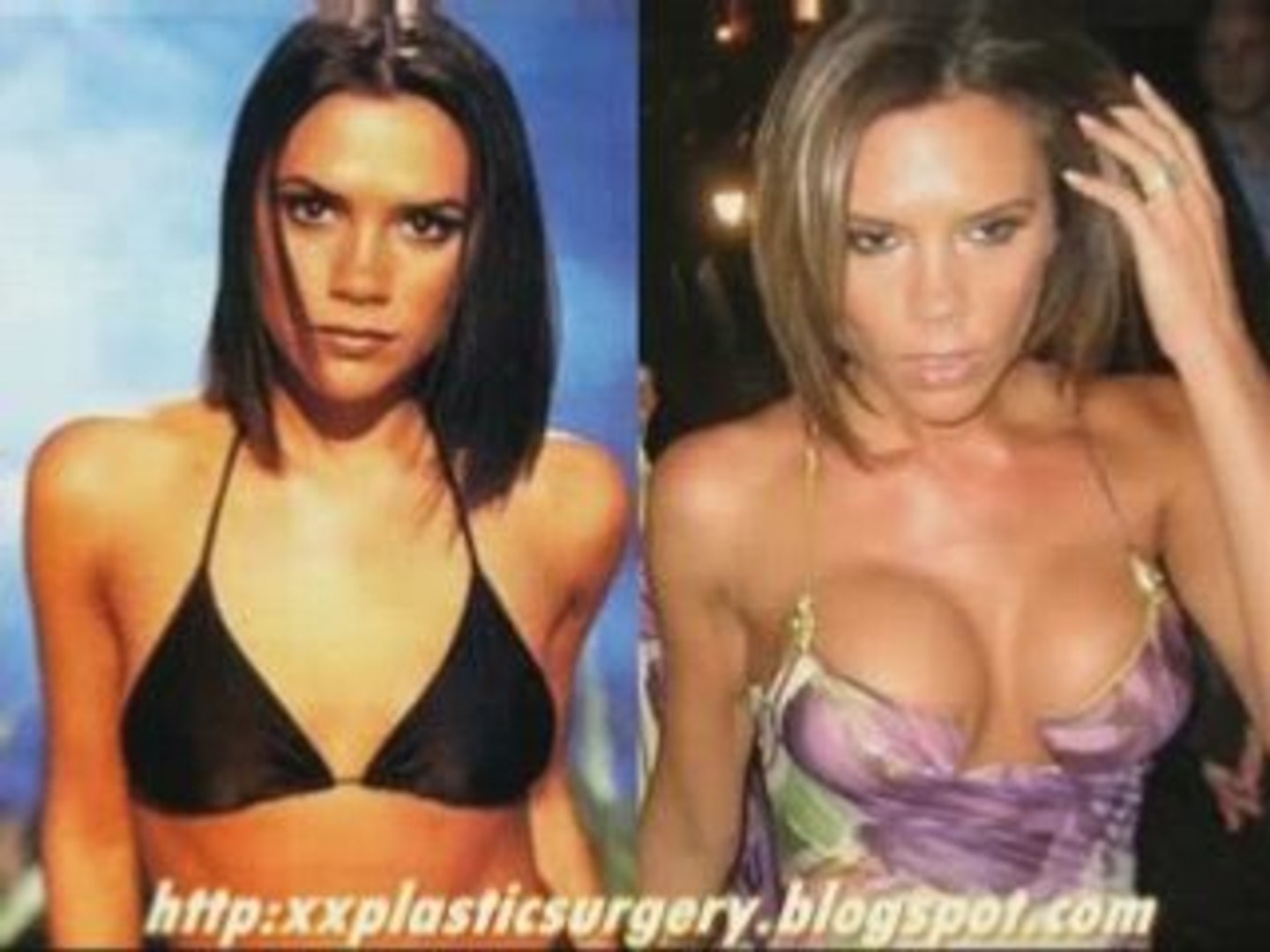 Plastic Surgery Before And After #7