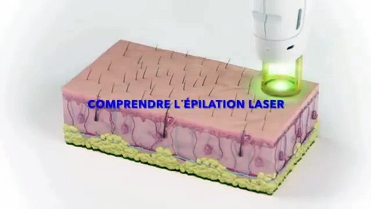 COMPRENDRE L'EPILATION LASER AU CENTRE MURANO