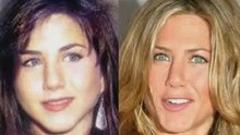 Plastic Surgery Before And After #6