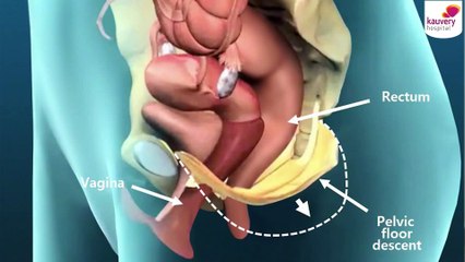 When to Consult a Doctor for Constipation in Middle-Aged Women