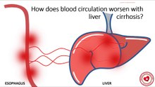 How does blood circulation worsen with liver cirrhosis?