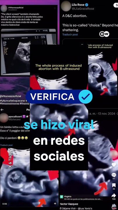 Sienten dolor los fetos durante un aborto?