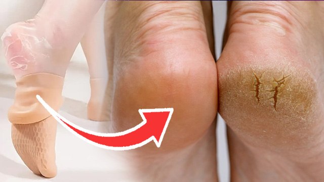 Silicon Socks For Cracked Feet: Dry Feet In Winter Remedy | Boldsky