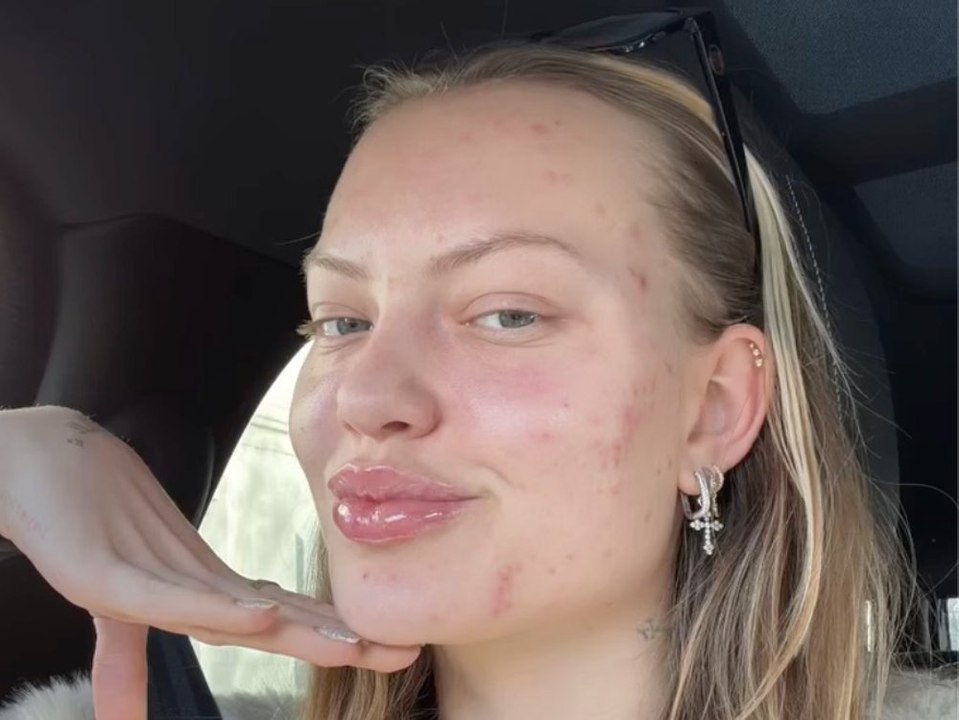 Cheyenne Ochsenknecht zeigt ungeschminkt ihre Akne