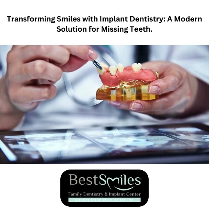 Transforming Smiles with Implant Dentistry: A Modern Solution for Missing Teeth