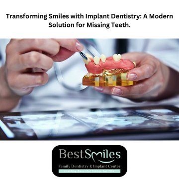 Transforming Smiles with Implant Dentistry: A Modern Solution for Missing Teeth