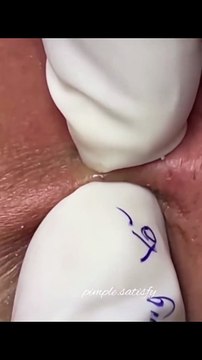 Deep Cleansing Facial for Oily Skin (ASMR)