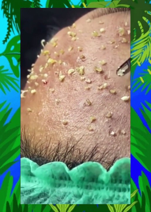 Blackhead Removal Tools: Are They Safe? (Acne Therapist Explains)