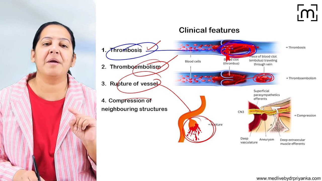 2. Aneurysm &Aortic Dissection