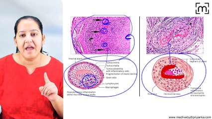 4. Vasculitis