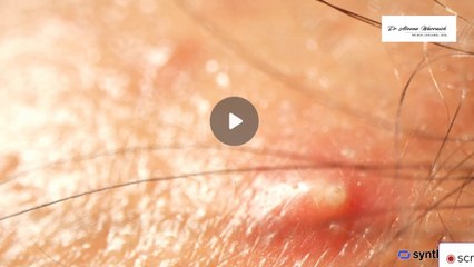 The Truth About Blackheads & How to Get Rid of Them!