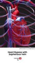 Heart Bypass Surgery Using Saphenous Vein: How It Works ❤️