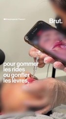 Envoyé spécial a enquêté sur les injections illégales d'acide hyaluronique