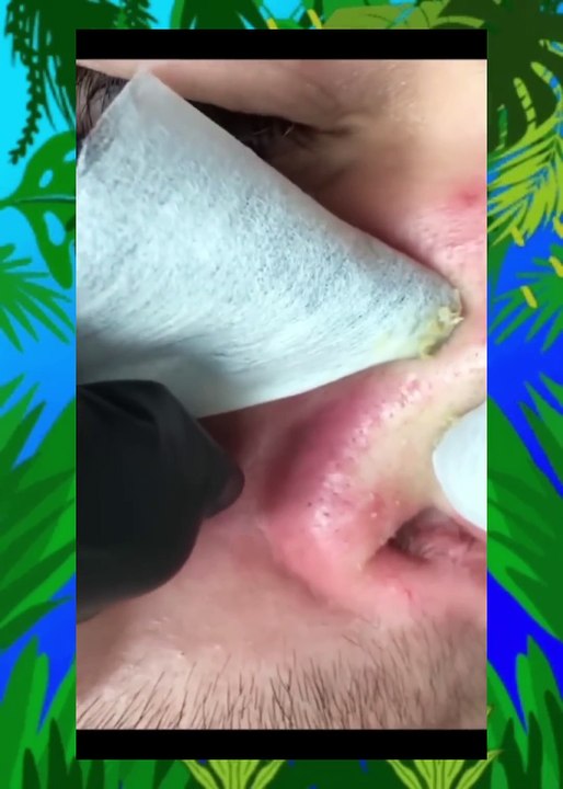 Gentle Nose Blackhead Extraction & Soothing ASMR | Skin Therapy Relaxation