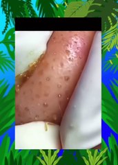 TreatmentWajah | Acne Treatment Facial at Home!