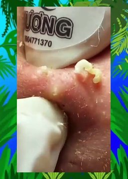 ASMR Deep Pore Cleansing Facial: Blackhead & Acne Extraction Therapy