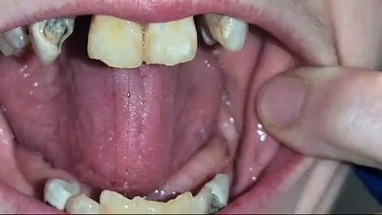 Candid video demonstrates woman's ongoing dental health issues