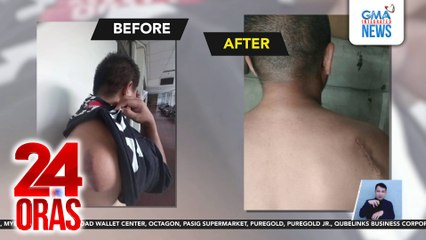 Libreng opera sa 17 taong may bukol, ikinasa ng GMAKF sa tulong ng JRMMC | 24 Oras