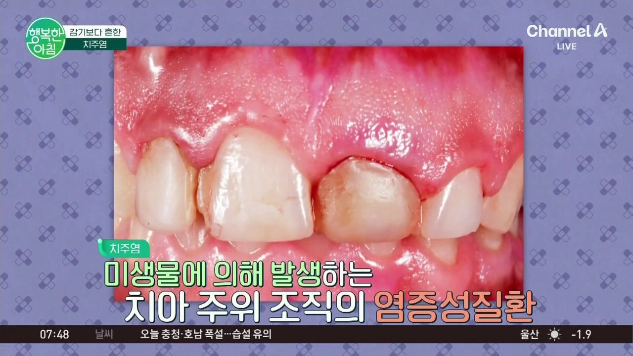 [닥터하우스] 감기보다 심한 치주염! 미리 예방하는 데 중요한 팁★ #치주염