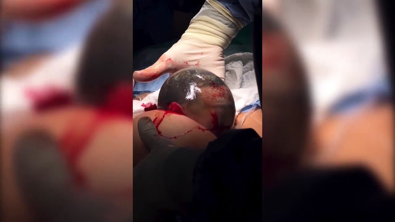 ext-Video- Omar Cascante muestra “velo” que cubrió a su bebé durante nacimiento-231224